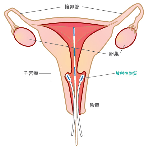 Intraluminal