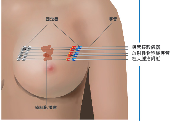 Implantation