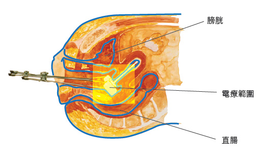 internal