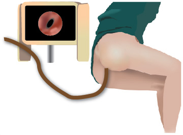test for colorectal cancer