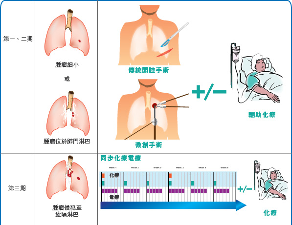 lung cancer treatment 1