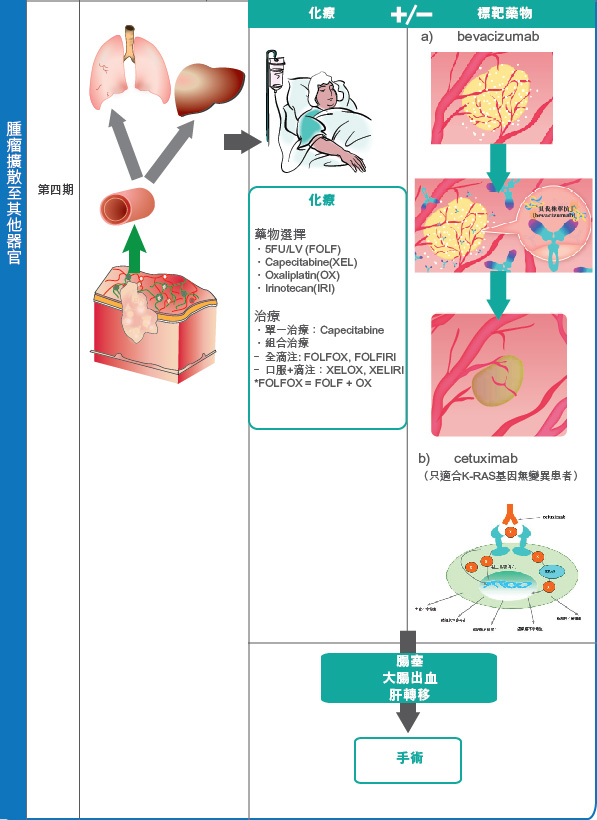 colorectal cancer treatment 2