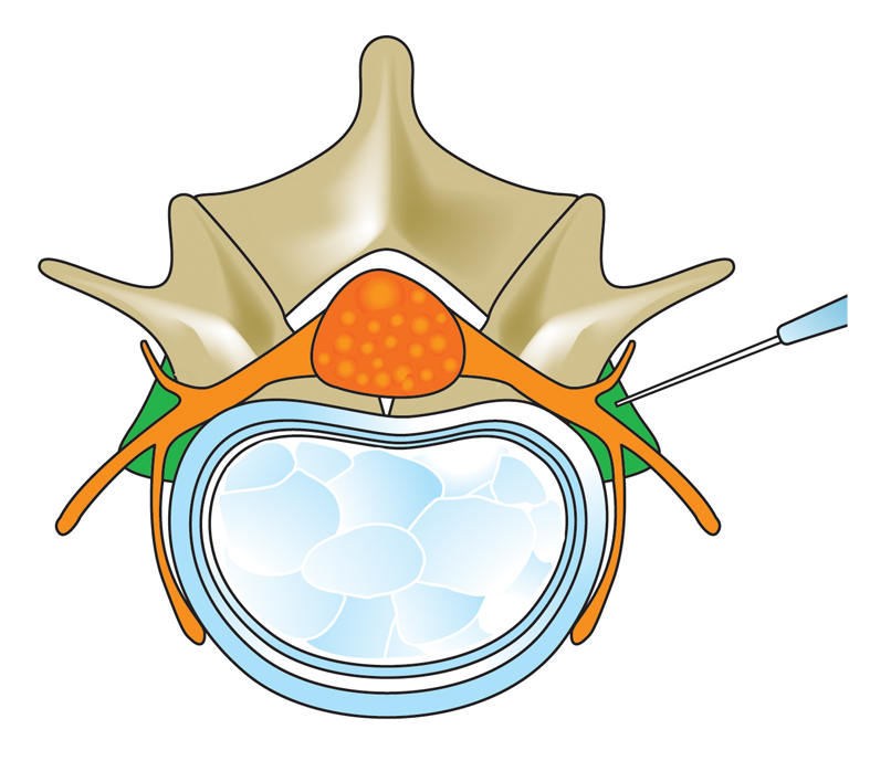 脊骨注射測試適宜的下針位置（綠色部份）