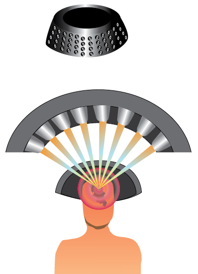 gamma knife