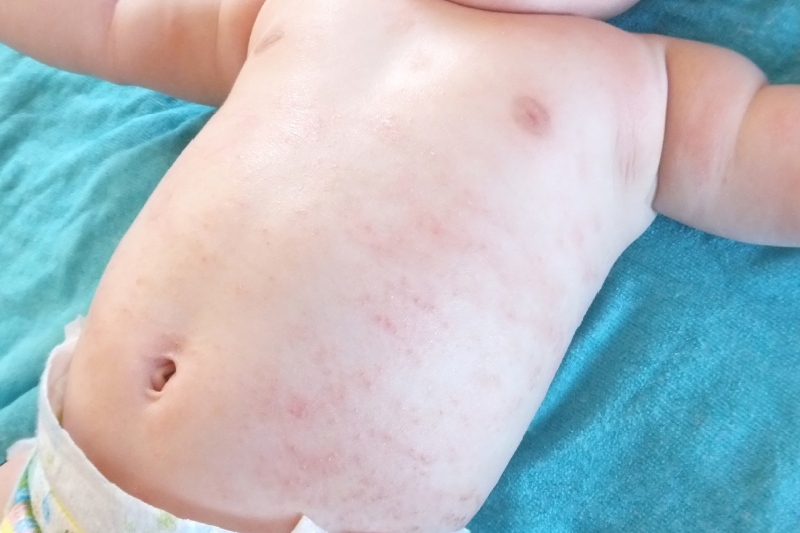 濕疹可根治?推介6款防敏配方潤膚霜及非類固醇濕疹藥膏