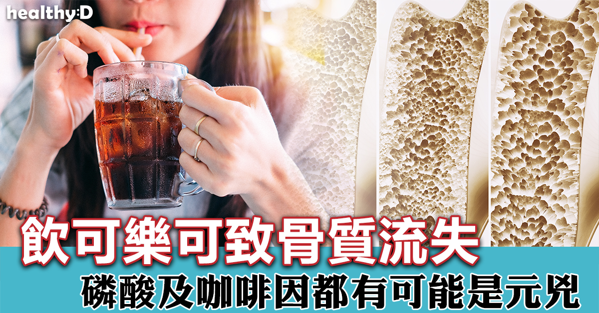 可樂可加快骨質流失 導致骨質疏鬆