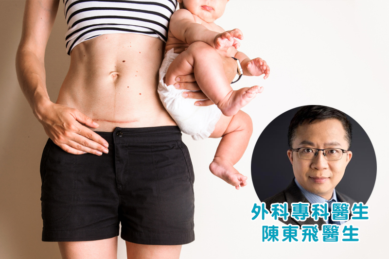 【產後除疤】開刀疤痕淡化時間要多久?疤痕增生怎麼辦?