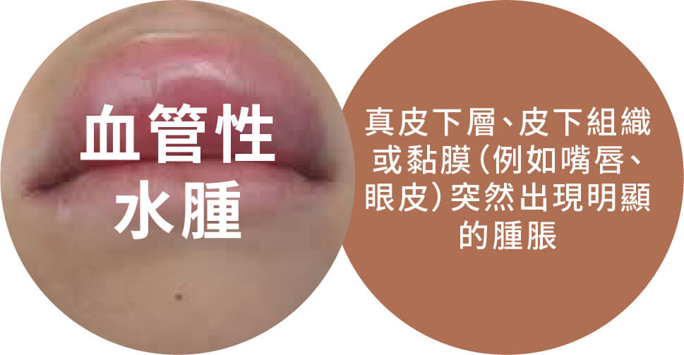 血管性水腫 真皮下層、皮下組織或黏膜（例如嘴唇、眼皮）突然出現明顯的腫脹