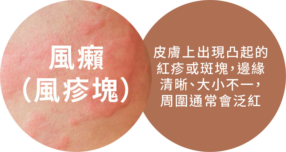 風癩（風疹塊）皮膚上出現凸起的紅疹或斑塊，邊緣清晰、大小不一，周圍通常會泛紅