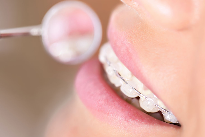 箍牙好處｜箍牙方法大比併｜哨牙應揀傳統牙箍定隱形牙箍？