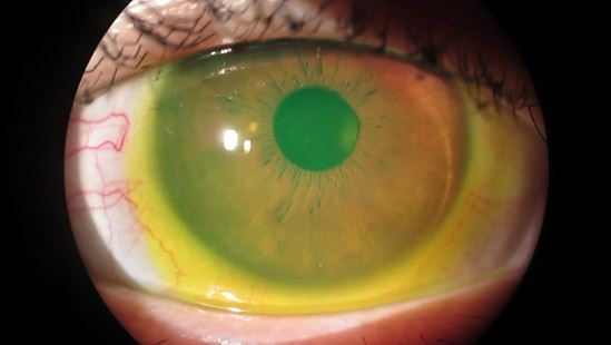 乾眼症女性長者多 眼科視光師講解治療及處理方法