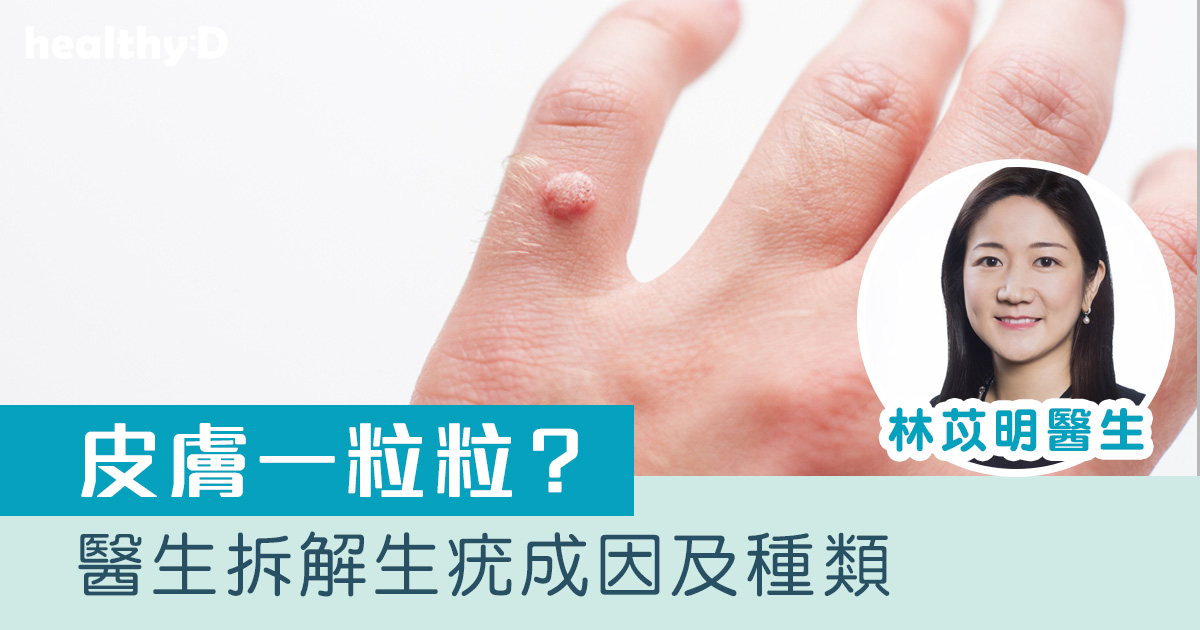 疣會傳染嗎