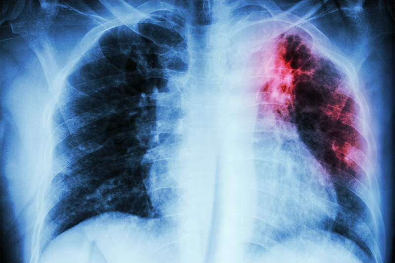 新冠肺炎可致肺纖維化？ 認識肺纖維化的徵狀及病因
