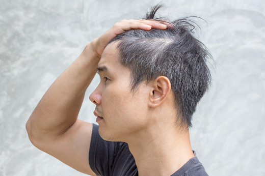 脫髮改善|脫髮原因是甚麼？防脫髮洗頭水可以防止甩頭髮？