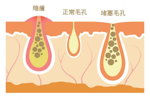 暗瘡 | 中西醫教你內外解決暗瘡問題：正確皮膚護理方法、食療、穴位、DIY去暗瘡印中藥面膜