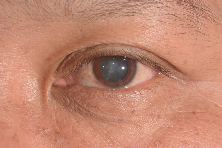 內障常見問題-「熟透」才可動手術？