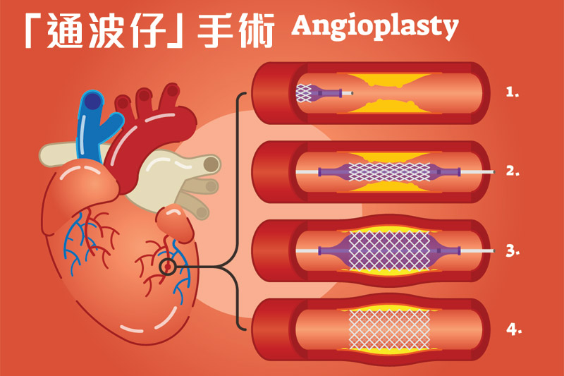 通波仔 | 呼吸急速、胸口壓著可能是冠心病症狀！認識通波仔手術原理、過程、風險及復發機會