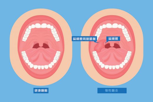 扁桃腺性病