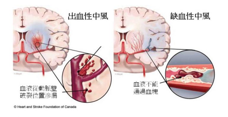 中風