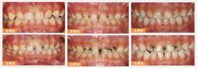 兒童蛀牙治療-氟化氨銀-3