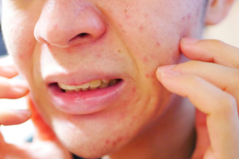 濕疹患者毋須絕望 應建立長遠希望