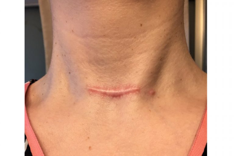 增生性疤痕 (Hypertrophic Scar) 徵狀