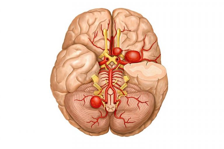 腦血管動脈瘤-中風-頭痛1