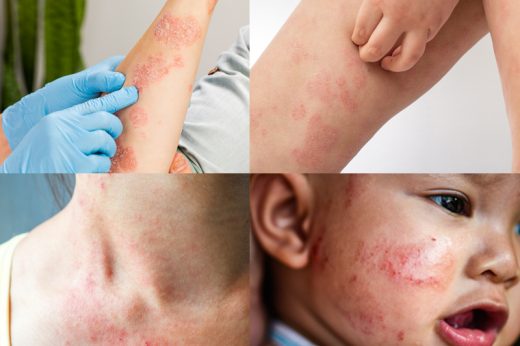 濕疹根治| 濕疹可自然好？皮膚專科醫生：治療用「鐵三角」認識濕疹成因、症狀、位置反映、種類、治療及飲食| Healthyd.Com