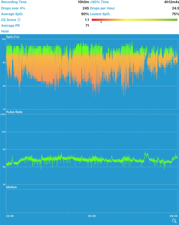 過夜脈搏血氧測試 (Overnight Pulse Oximetry)