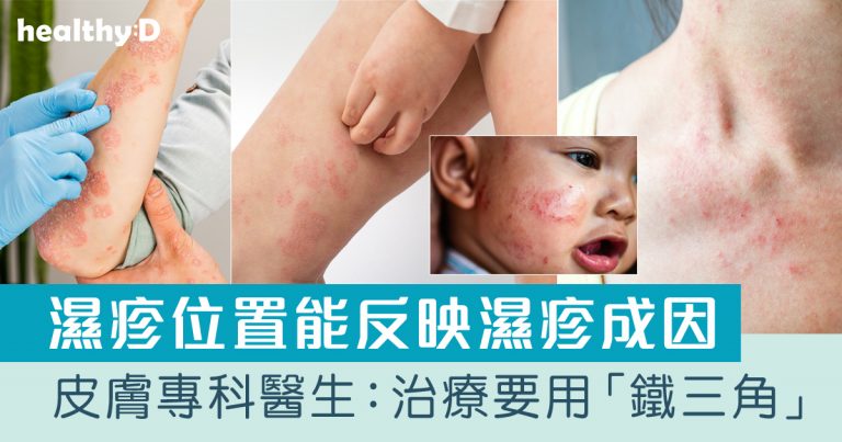 濕疹根治 | 濕疹會自己好嗎？會傳染或擴散？治療要用「鐵三角」拆解慢性濕疹原因/飲食/症狀/止癢方法(附濕疹照片)