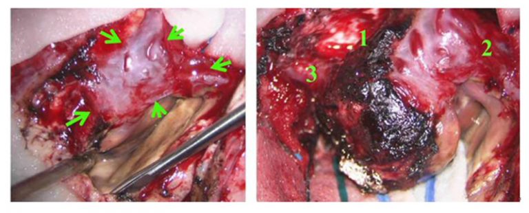 中風-清除血塊後，在顯微鏡下切除腦先天性動靜脈畸形血管