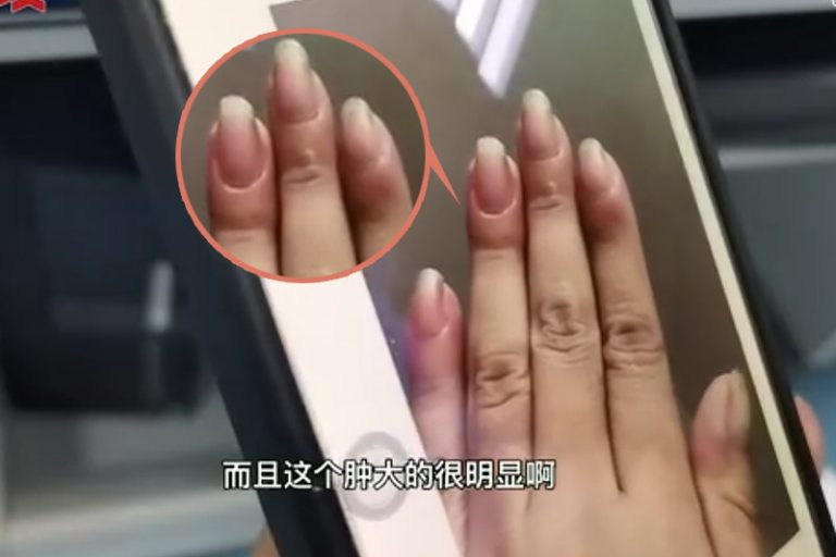 杵狀指