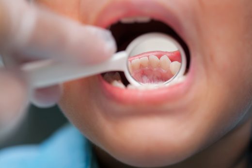 幼童牙科保健 | 孩子害怕看牙醫，可以如何處理？