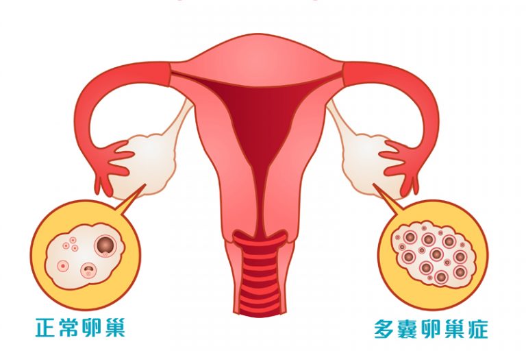 多囊卵巢症-不孕-經期不準4