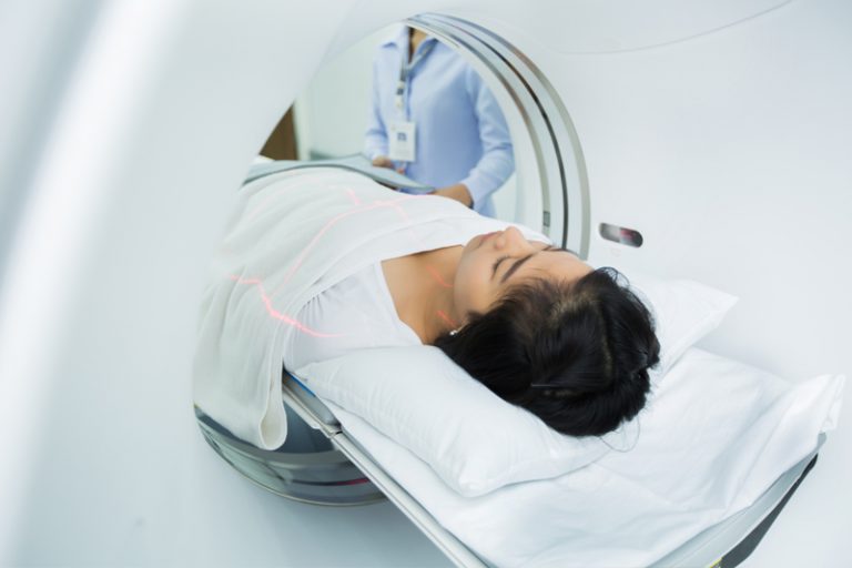 糖尿病併發症-單邊鬥雞眼-腦掃描