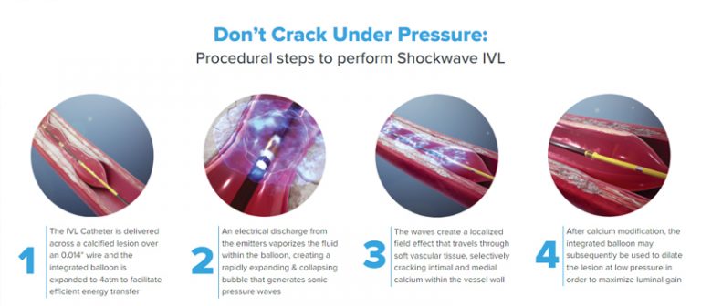 冠心病嶄新療法-通波仔手術