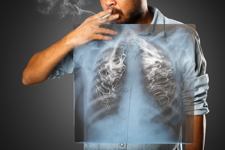 肺癌前兆-咳嗽半年確診肺癌-吸煙-檢查