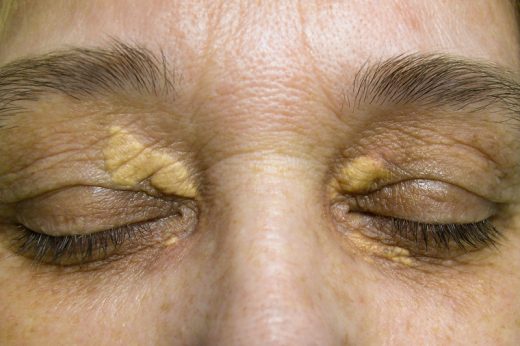黃斑瘤 | 中年女士眼皮長黃斑點要清除嗎？醫生詳解黃斑瘤成因、診斷及激光手術治療