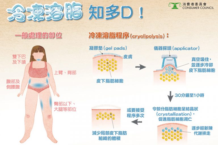 消委會.冷凍溶脂有無用?