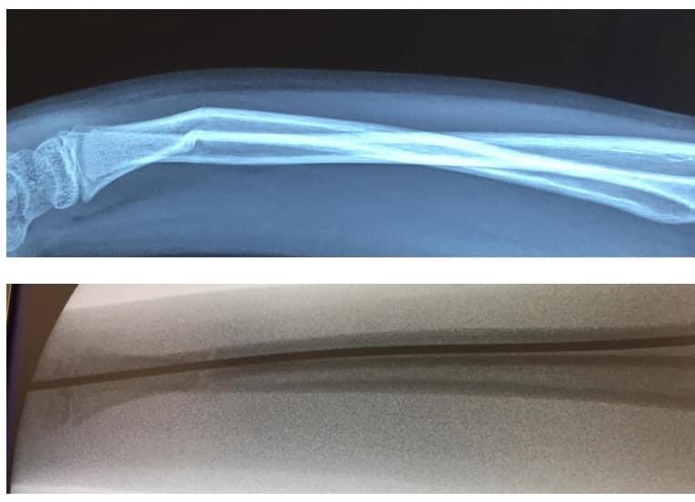 兒童前臂骨折-康復時間-X光判斷-3