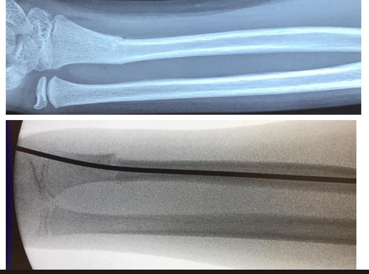 兒童前臂骨折-康復時間-X光判斷4