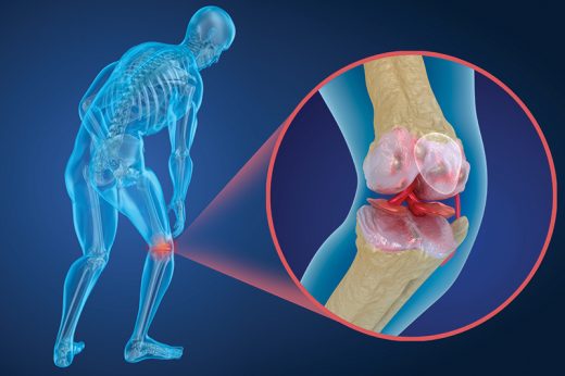 骨質疏鬆趨年輕化 及早檢查防骨折 | 骨質疏鬆吃甚麼？醫生拆解成因、診斷、預防及治療方法