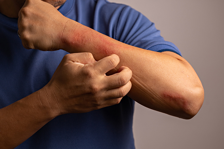 嚴重異位性皮膚炎