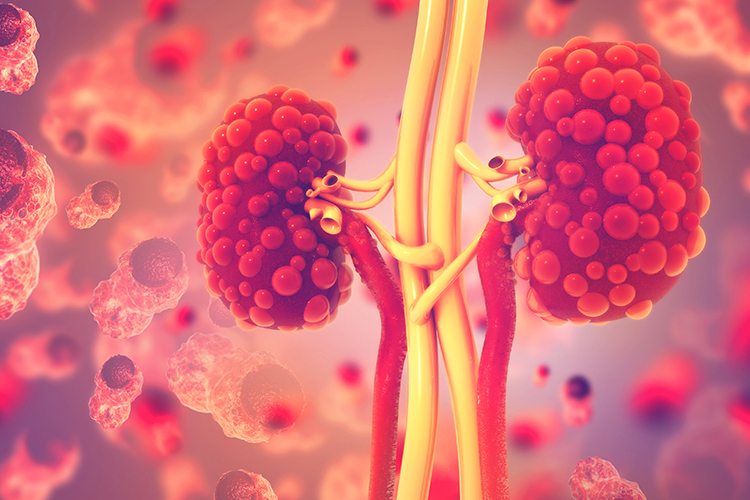 常染色體顯性多囊性腎臟病（ADPKD）