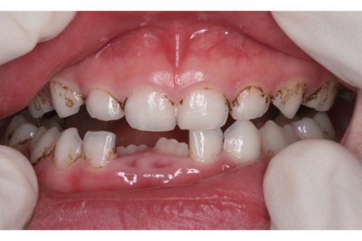 【小朋友的牙漬問題】專家教你去牙漬及預防方法