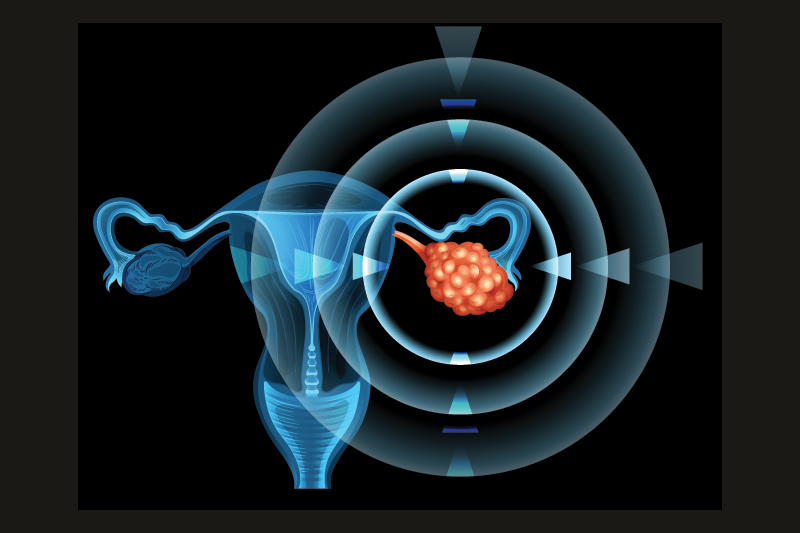 卵巢癌|症狀難發現？一文了解卵巢癌症狀及檢查方法
