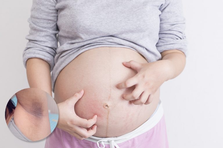 懷孕皮膚問題-妊娠紋-黑色素-乾燥過敏-痕癢