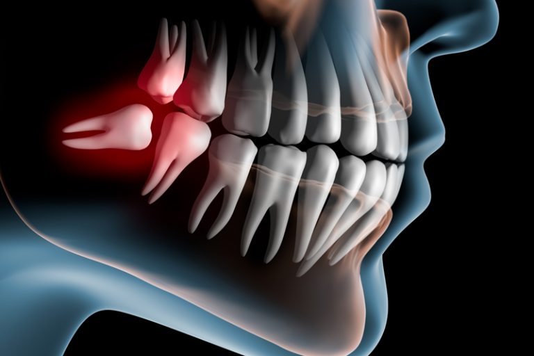 智慧齒不夠位生長-蛀牙-牙周病-冠周炎-牙齒囊腫
