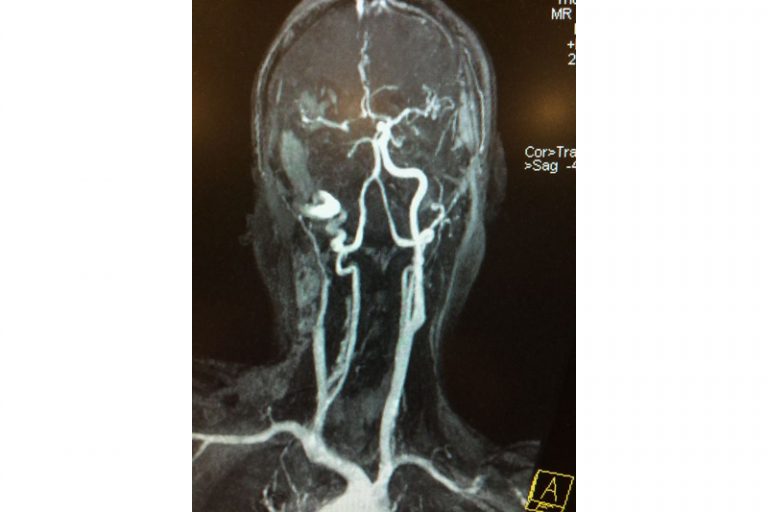 缺血性中風-急救-手術治療-個案-腦血管外科