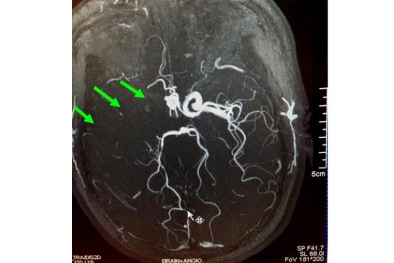 缺血性中風-急救-手術治療-個案-腦血管外科